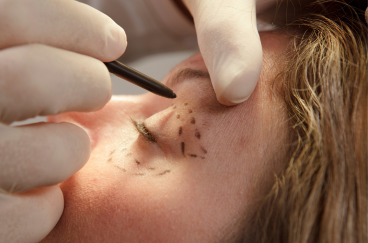 Oculoplasty