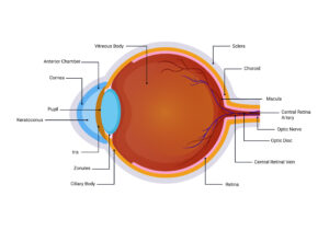 Keratoconus